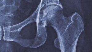 X-ray image of hip joint with signs of coxarthrosis